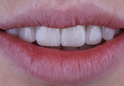 Красиви зъби - как да се направи и колко струва