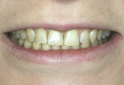 Красиви зъби - как да се направи и колко струва