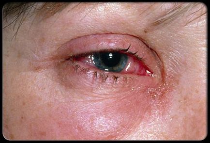 Red Eye протеини причини, ефекти и лечения (очни) протеини червени очи причини, ефекти и лечения