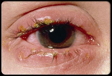 протеини червени очи причини, ефекти и лечения
