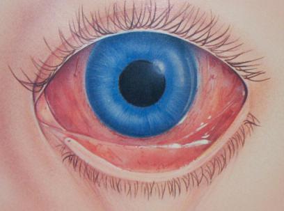 протеини червени очи причини, ефекти и лечения