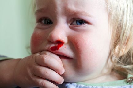 Кръв от носа на 10 причини на детето