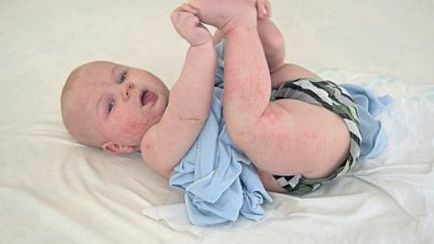 Лечение на атопичен дерматит при деца народни средства за защита (26 снимки)