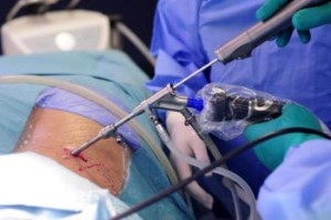 Лечение и лазерна операция херния отстраняване на шийните прешлени диск и изпаряване
