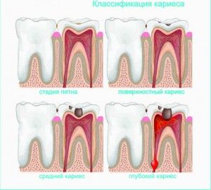 кариес лечение у дома и в стоматологията