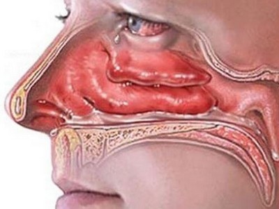 Лечение на оток на лигавицата на носа, отколкото да се премахне задръстванията у дома