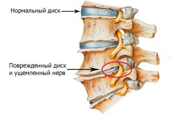 chondrosis домашно лечение