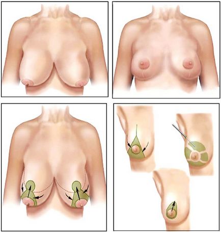 Намаляване мамопластика - какво е това и в кои случаи е необходимо