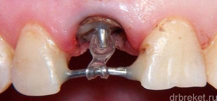 Методи за протези млечните зъби на вида на детето на протези
