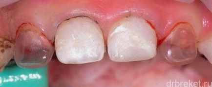 Методи за протези млечните зъби на вида на детето на протези
