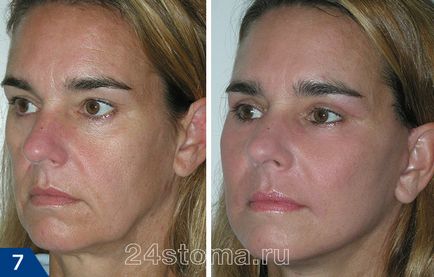 Mezoniti - отзиви, снимки преди и след козметична операция, негативните ефекти