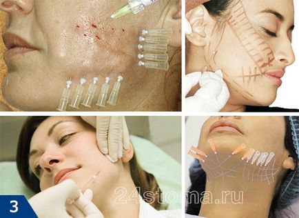 Mezoniti - отзиви, снимки преди и след козметична операция, негативните ефекти