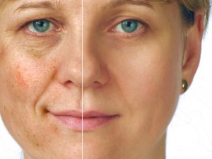 Фолк средства за старчески петна по лицето Как да се отървем, премахване на петна и озарява