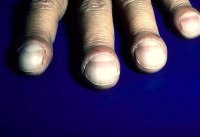 Nails - стъклен - причините за симптом