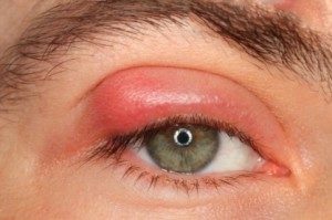 Подуване на очите алергии - какво да правя