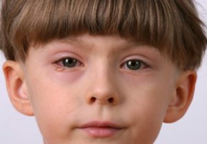 Подуване на очите алергии - какво да правя