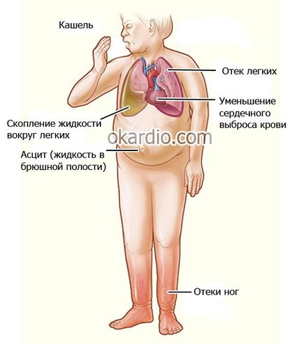 подуване на краката в сърдечна недостатъчност причини, симптоми, лечение