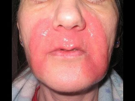 Изгаряния по лицето на правилното лечение