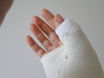 Фрактура на малкия пръст, палецът на симптомите за ръка и лечение, как да се идентифицират