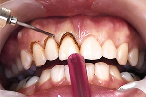 Пародонтит, зъб - това, което е той подписва със снимки, домашно лечение