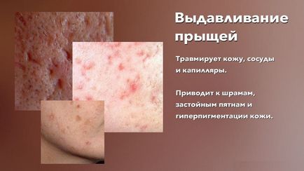 Защо не може да изтръгне пъпки последици от притискане на кожата на лицето и тялото