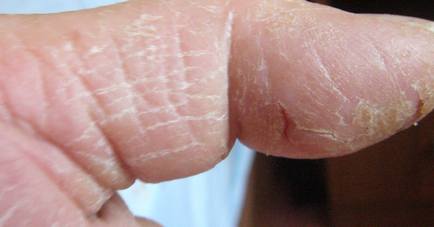 Защо е суха и напукана кожа на ръцете, кожни заболявания