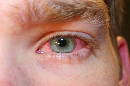 Зачервяване на окото симптоми, причини и лечение