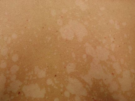 Външният вид на бели петна по кожата на какво е, как да се отнасяме светлите петна по гърба и тялото снимките