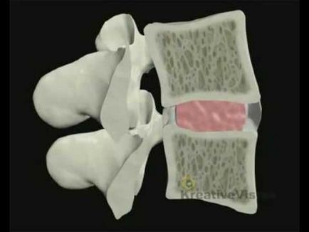 Причините за възникването и развитието на гръбначния херния