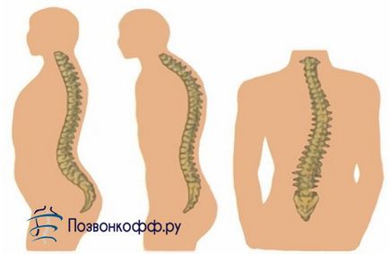 Причините за възникването и развитието на гръбначния херния