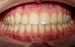 Протеза предните горни и долни зъби