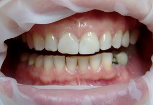 Протеза предните горни и долни зъби