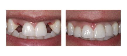 Протеза предни зъби