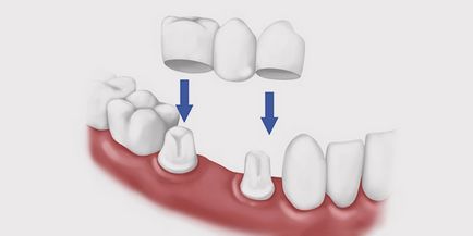 Протезиране на предните зъби на горната и долната видове и материали
