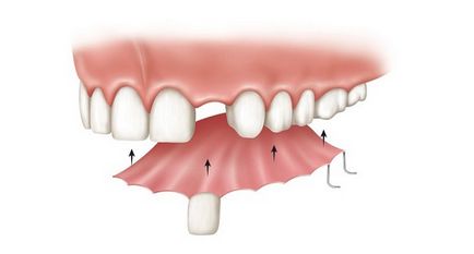 Протези на предни зъби - всички видове протези за предните зъби