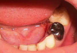Ортопедична зъби при децата, детски протези