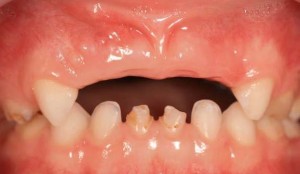 Ортопедична зъби при децата, детски протези