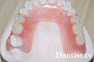 Зъбни протези найлон цена, видове и снимки