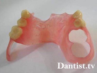 Зъбни протези найлон цена, видове и снимки