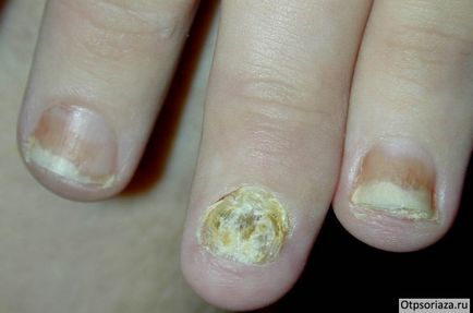 Псориазис снимката ръце причини лечение етап и (псориазис) Псориазис по ръцете на снимка, сцена, лечение и причини