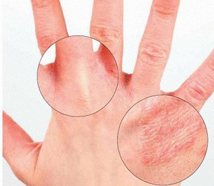 Псориазис по ръцете първоначален етап - псориазис върху отношението му ръце