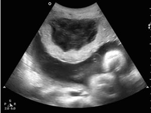 Местоположение на плацентата на предната стена на протичането на бременността и потенциалните рискове