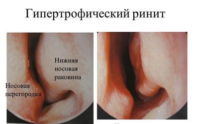 Ринит при деца симптоми и лечение, причини