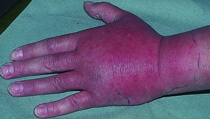 Еризипел ръце симптоми и лечение на еризипел ръцете на народната медицина