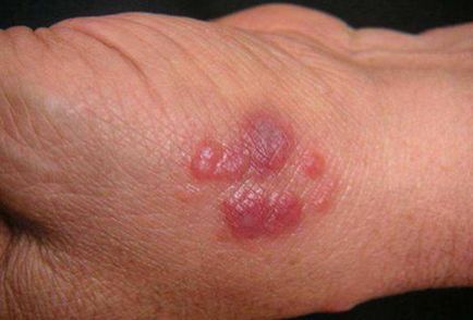 Еризипел ръце симптоми и лечение на еризипел ръцете на народната медицина