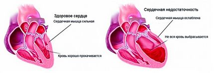 Симптомите на сърдечна недостатъчност, остра и хронична при жените