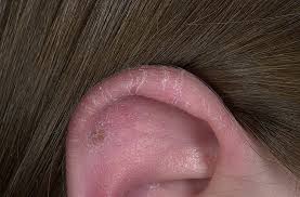 Обриви по ушите причини, диагностика, лечение
