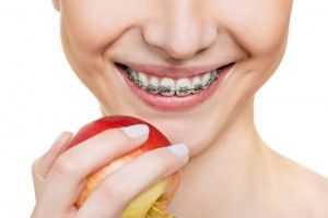Staples за зъби колко струва да се поставят върху зъбите на детето си