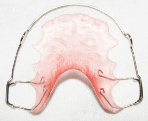Staples за зъби колко струва да се поставят върху зъбите на детето си