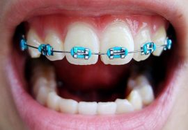 Скоби за зъбите на децата и възрастните снимки - преди и след, колко са стоматологични скоби